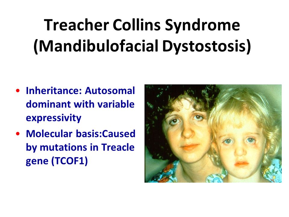 What is Treacher Collins syndrome?